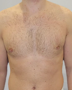 Patient 3, after male breast reduction