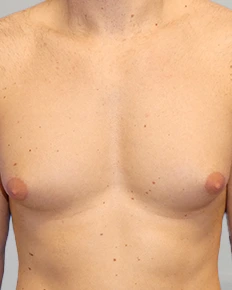 Patient 3, before male breast reduction