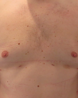 Patient 4, after male breast reduction