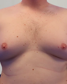 Patient 4, before male breast reduction
