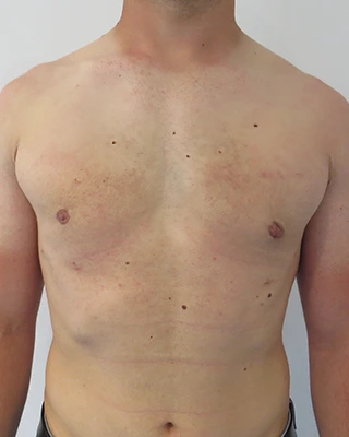Patient 2, after male breast reduction