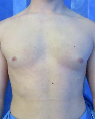 Patient 2, before male breast reduction