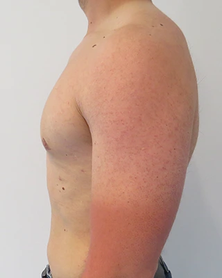 Patient 6, after male breast reduction