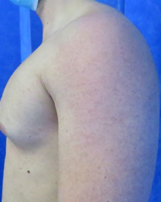 Patient 6, before male breast reduction