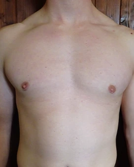 Patient 1, after male breast reduction