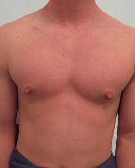 Patient 1, before male breast reduction