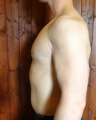 Patient 5, after male breast reduction