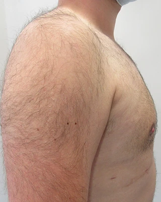 Patient 7, after male breast reduction